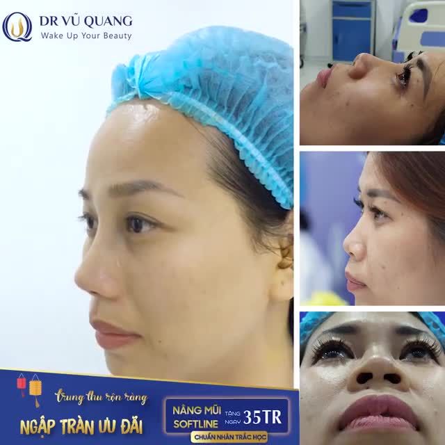 Nâng MŨI  CẤU TRÚC SOFTLINE PLUS - Đẹp không cần nẹp