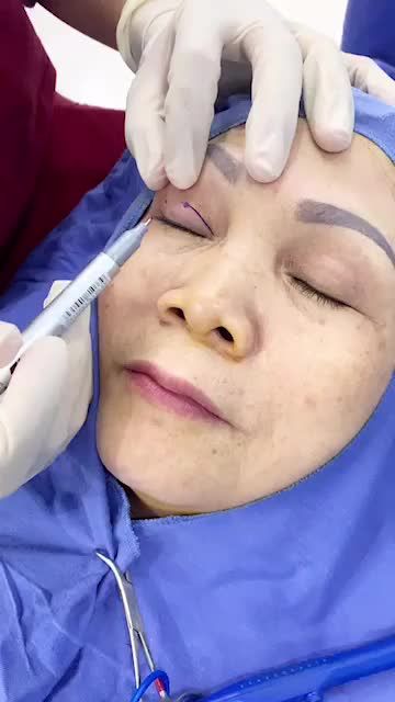 Quá trình đo vẽ thiết kế mí mắt và gây tê cục bộ trước phi phẫu thuật cắt mí