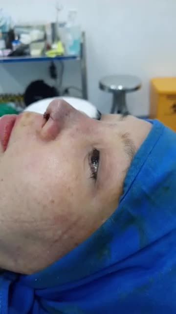 NÂNG MŨI BÁN CẤU TRÚC ĐA LỚP  Dáng Sline tự nhiên sau 45 phút