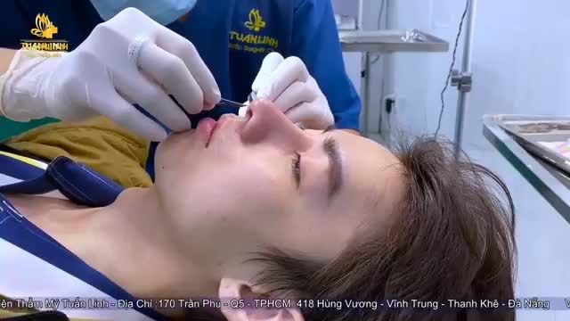 Khách hàng sử dụng dịch vụ nâng mũi cấu trúc - Tái khám sau 10 ngày !