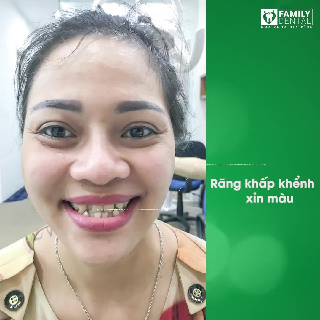 NỖI ÁM ẢNH KINH HOÀNG MANG TÊN RĂNG XẤU