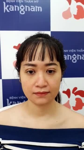 CẮT MÍ - Sợ SƯNG LÂU ảnh hưởng công việc?