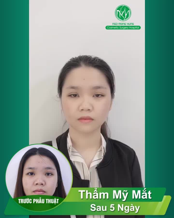 Ta Nói Đi Thẩm Mỹ Mắt Gì Mà Như Đi Chơi Vậy