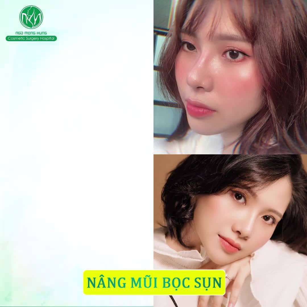 Cô Nàng 9X Thay Đổi Thế Nào Sau 1 Năm Nâng Mũi Bọc Sụn Tai