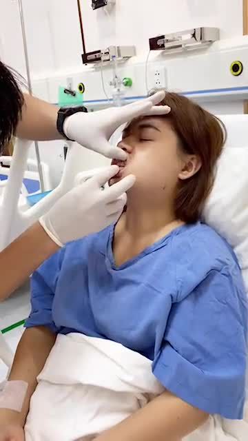 Hàm móm độ 2, gãy tầng mặt giữa, cười thiếu tự nhiên