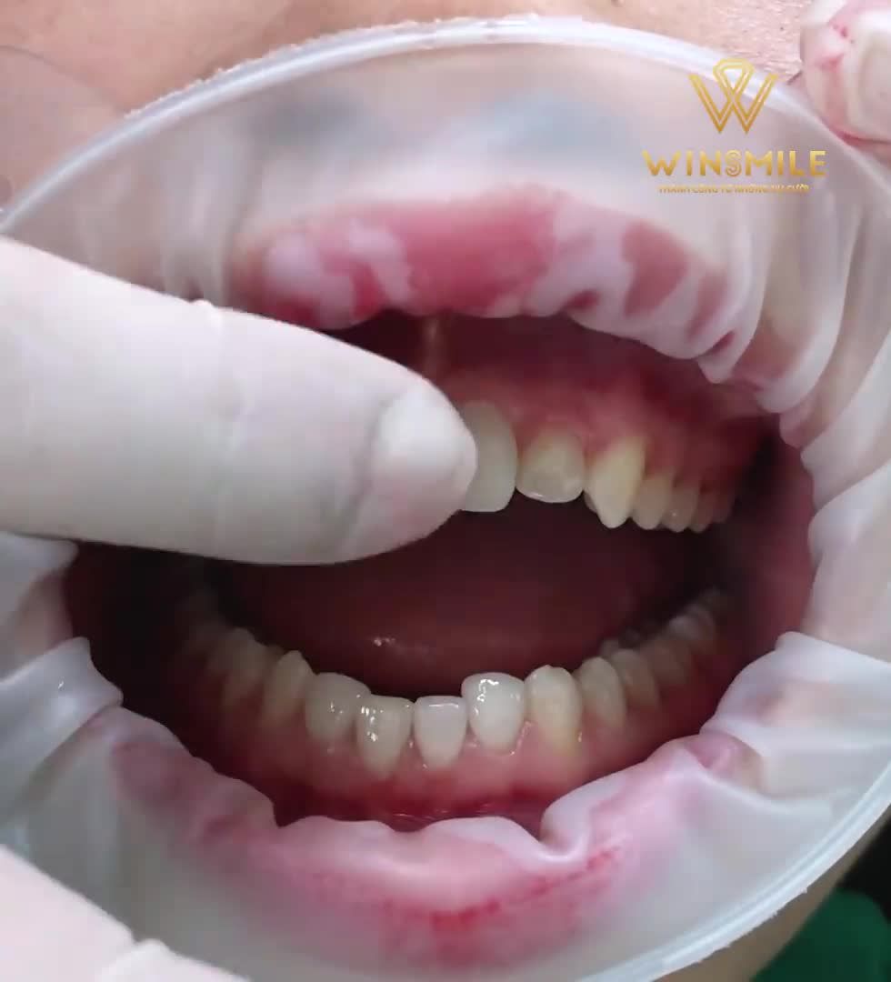 Khách hàng nữ 23 tuổi, muốn cải thiện khớp cắn ngược và thẩm mỹ lại nụ cười về hình thể răng với mặt dán sứ Veneer
