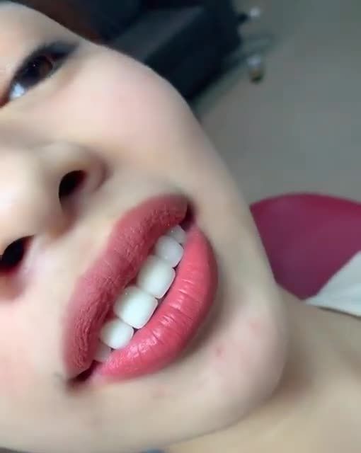 Khách Hàng Sau Khi Làm " 16 Răng Sứ Cao Cấp DDBIO " Tại Almar Dental