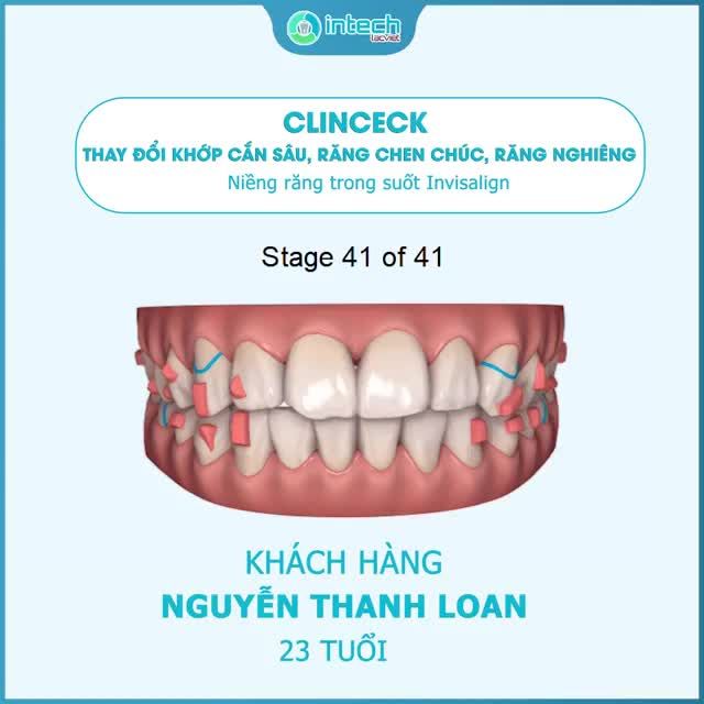 KHÔNG PHỎNG ĐOÁN - KHÔNG CHỜ ĐỢI VÀ XEM TRƯỚC KẾT QUẢ CHÍNH XÁC SAU NIỀNG RĂNG