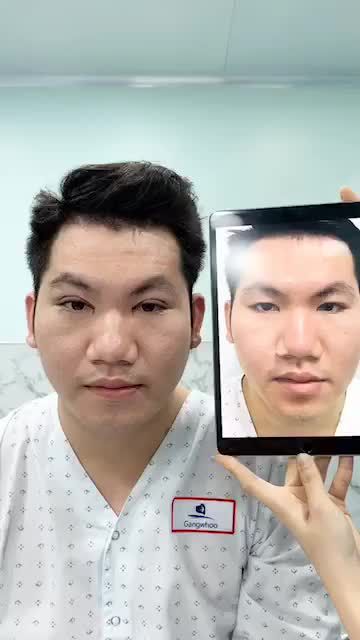 Mắt ELIP và mở góc mắt trong nam thần xuất hiện với đôi mắt cực kì có sức hút chỉ với 30 phút mà thôi