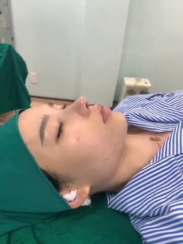 MŨI SỬA LẠI CẤU TRÚC cho em gái nâng mũi 8 năm trước, mũi to, lệch, lộ sóng, dáng mũi chưa cao bay, thon như em muốn.
