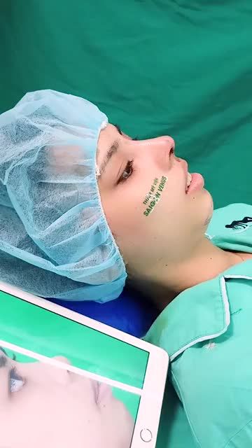 NÂNG MŨI CẤU TRÚC FASCIA - PHƯƠNG PHÁP ĐỘC QUYỀN TẠI SAIGONVENUS