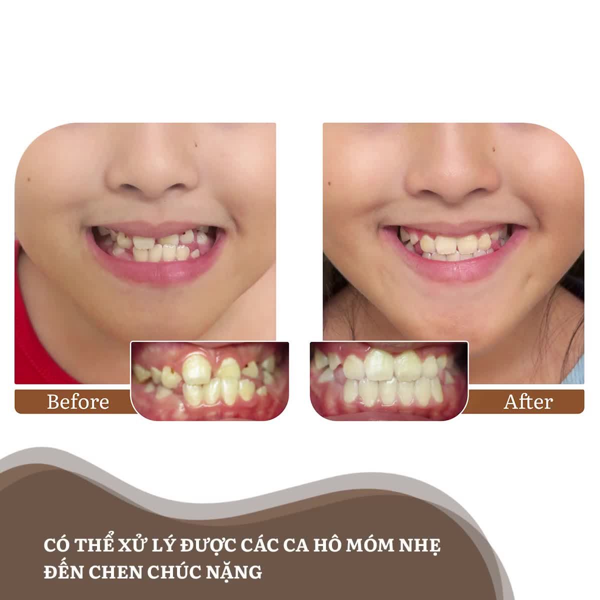 NIỀNG RĂNG CA KHÓ, ĐÃ CÓ BÁC SĨ MINH KHAI