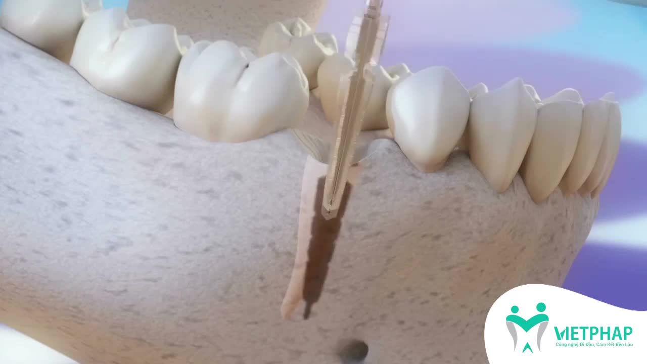 Tác Hại Khôn Lường Của Việc Mất Răng Lâu Ngày