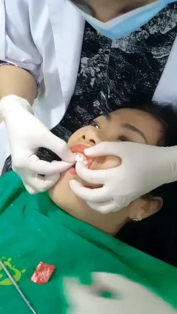 ƯỚM THỬ VENEER SỨ LÊN RĂNG CHO KHÁCH HÀNG