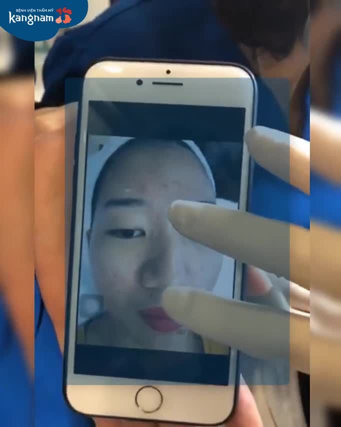 Da "hồi sinh" sau 6 buổi trị mụn