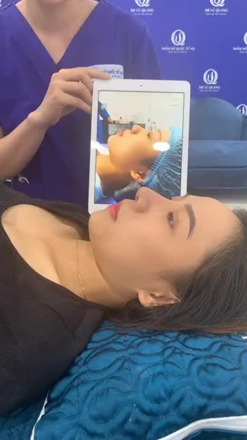 Ngỡ ngàng trước sự thay đổi của khách hàng sau 3 tháng thực hiện Combo Nâng Mũi Softline + Cắt Mí Baby Eyes 6D.
