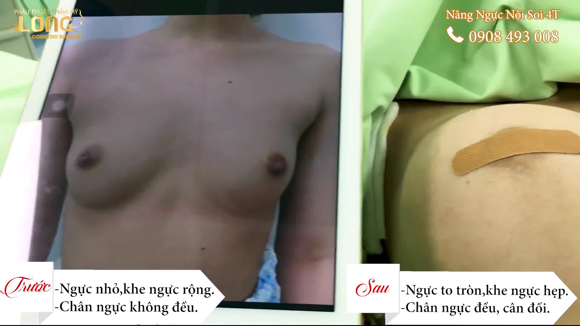 NÂNG NGỰC NỘI SOI SỬ DỤNG THIẾT BỊ HIỆN ĐẠI GIÚP CAN THIỆP CHÍNH XÁC ÍT XÂM LẤN