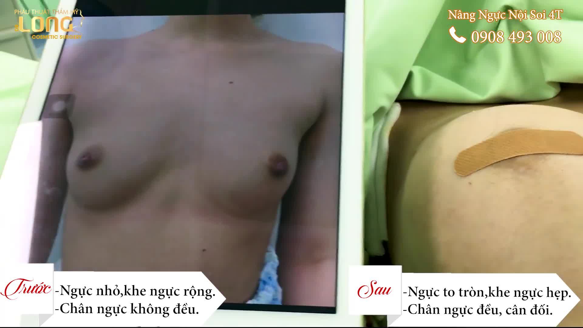 Cận Cảnh Nâng Vòng 1 Nội Soi 4T Túi Tròn