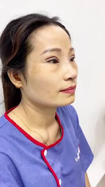 Kết quả nâng mũi - cắt mí tại Kangnam sau hơn 1h phẫu thuật Bấm xem ngay