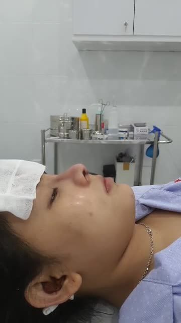 NÂNG MŨI CẤU TRÚC SAU TIÊM GIẢI FILLER Mọi người cùng vào xem kết quả và giao lưu cùng bạn gái xinh đẹp nhé!