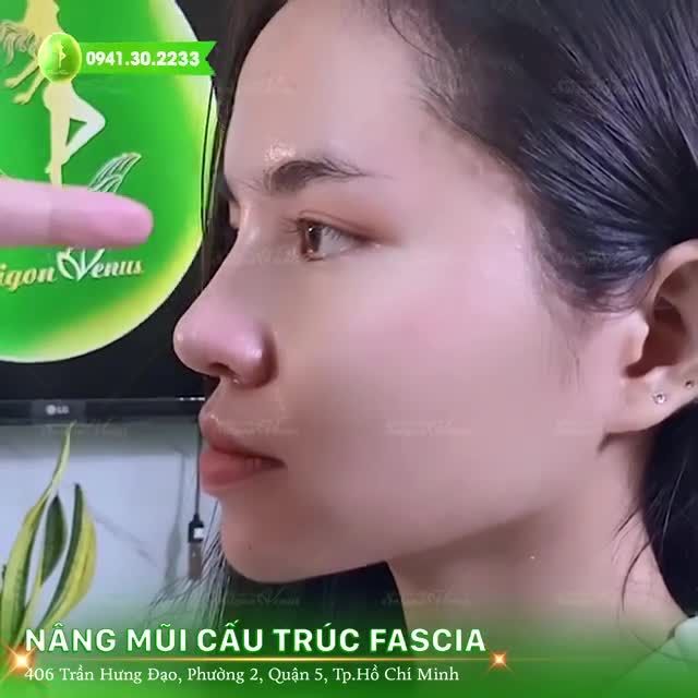 NGỌC ANH TÁI KHÁM NÂNG MŨI CẤU TRÚC FASCIA