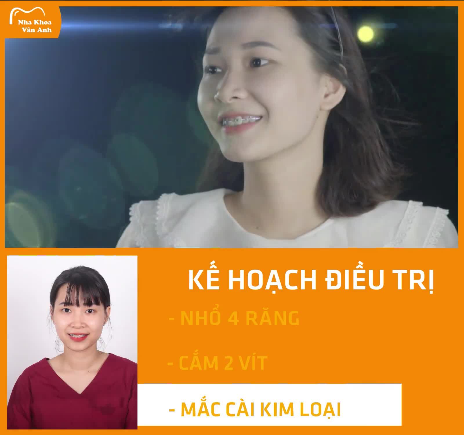 "Thị Nở " lột xác sau 24 tháng niềng răng!!!