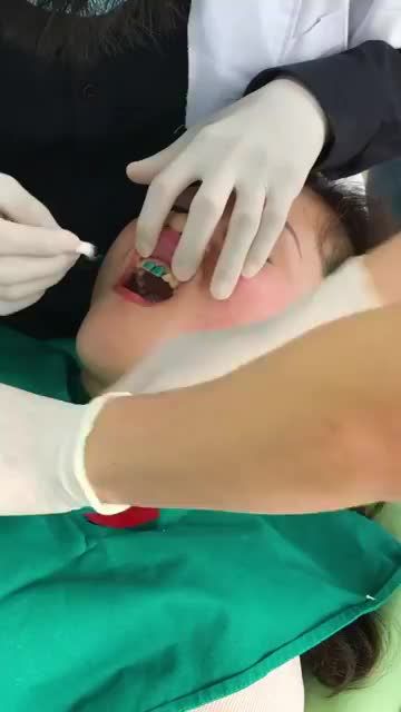 Quá trình dán sứ Veneer cho KH Nguyễn Thị Thắm