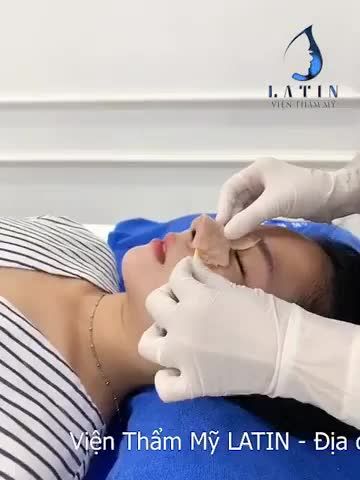 QUY TRÌNH THÁO NẸP MŨI SAU 7 NGÀY TẠI LATIN
