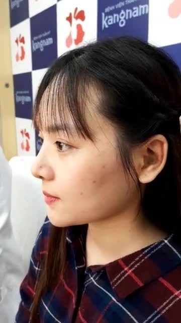 Đầu mũi ngắn - lỗ mũi to - Cánh mũi bè Nữ khách hàng gây ngỡ ngàng với nhan sắc "cực đỉnh" sau 10 ngày Nâng nũi cấu trúc 4D Nanofrom