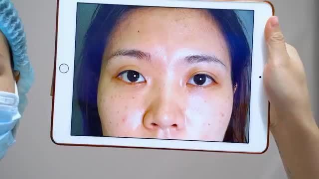 CẮT MÍ TẠI DR.HẢI LÊ KHẲNG ĐỊNH ĐẸP ĐẾN 90% NGAY SAU KHI THỰC HIỆN VÀ ĐẸP VÔ CÙNG TỰ NHIÊN ĐẾN 99% SAU 6 THÁNG.!