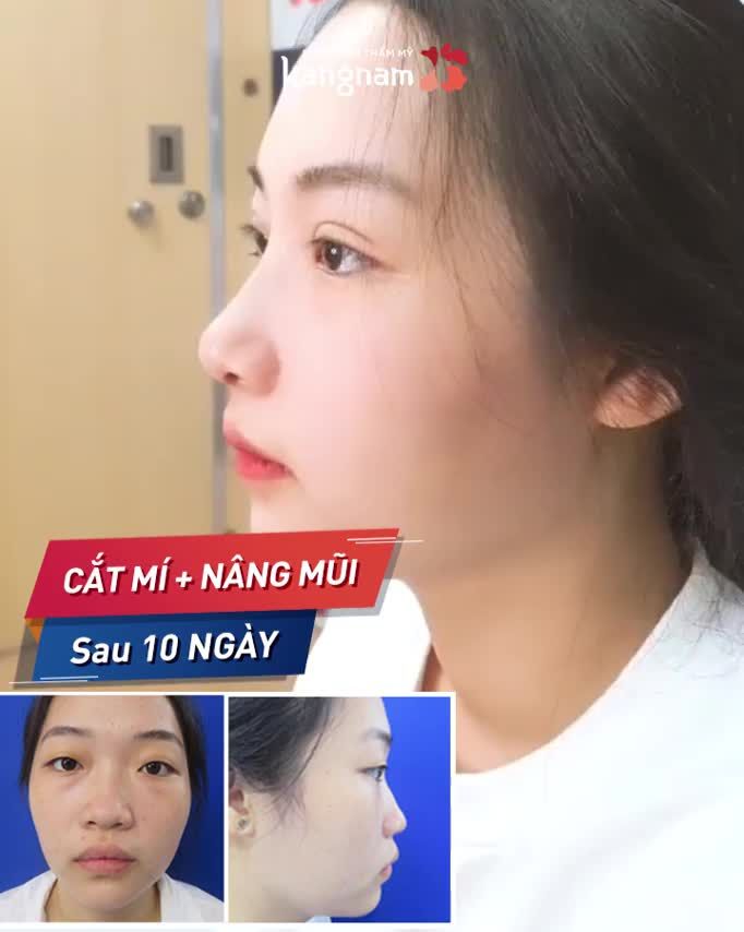 Thẩm Mỹ: 2 DỊCH VỤ cũng ĐỦ LỘT XÁC!