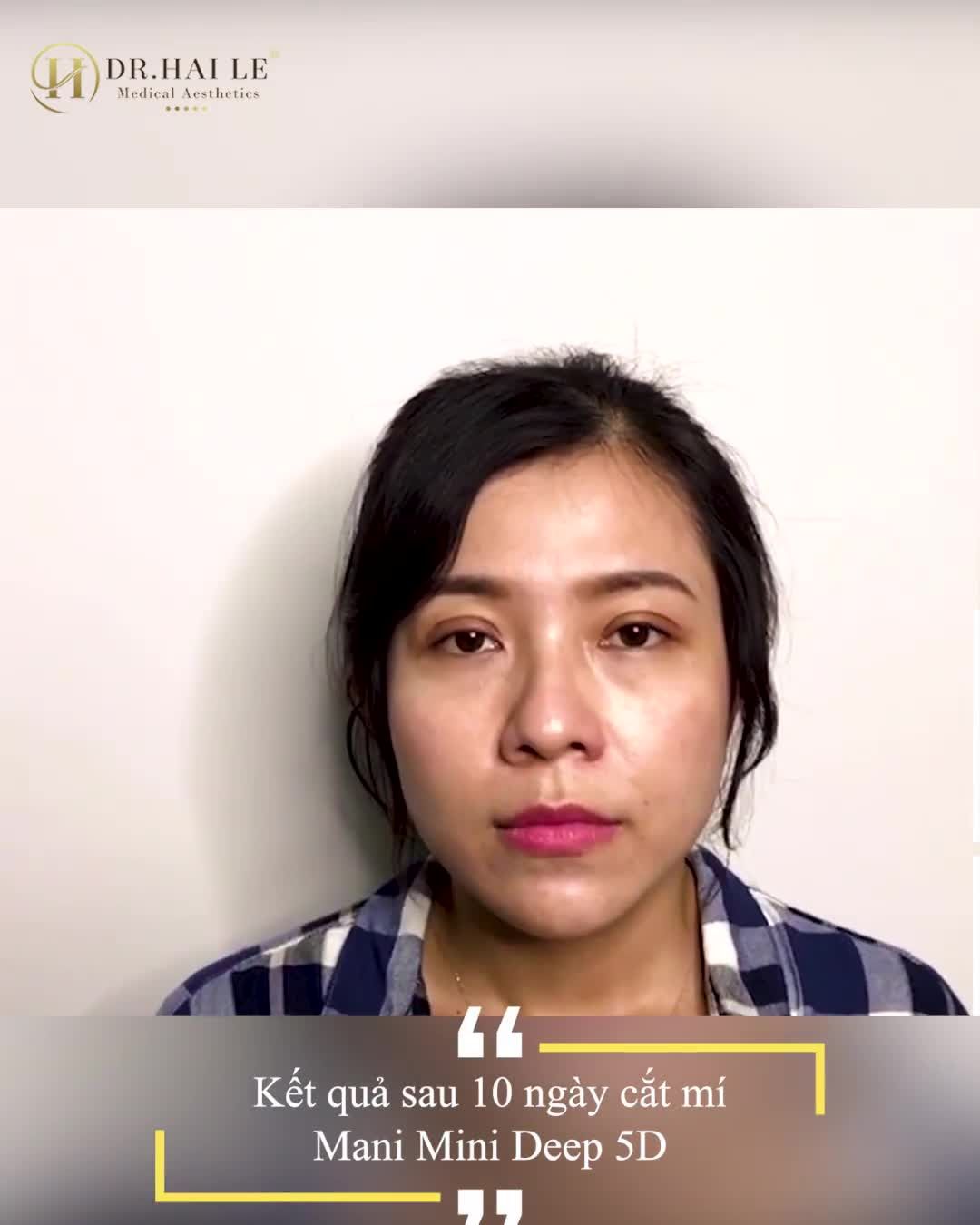CHẮC CHẮN YÊU LÀ ĐÂY.!!  Nếp mí đẹp hoàn hảo chỉ sau 60 phút thực hiện.