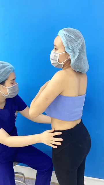Kết quả hút mỡ eo và cấy mỡ hõm mông. Chỉ sau 7 ngày có ngay vòng eo con kiến + bờ mông trái đào gợi cảm