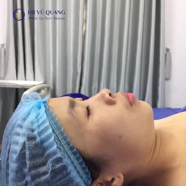 Nâng mũi Softline - Đẹp ngay sau khi làm
