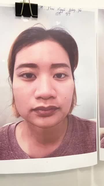 KHẮC PHỤC KHUYẾT ĐIỂM MŨI TO