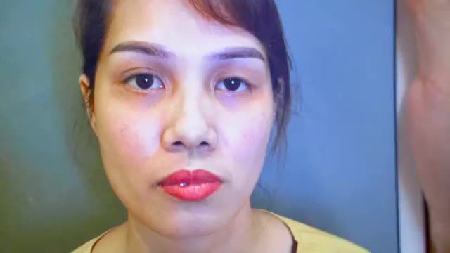 GIẢI CỨU thành công ca mí mắt khó vừa lỗi hỏng do phẫu thuật nhiều lần không thành công vừa nhược cơ nâng mi bẩm sinh!