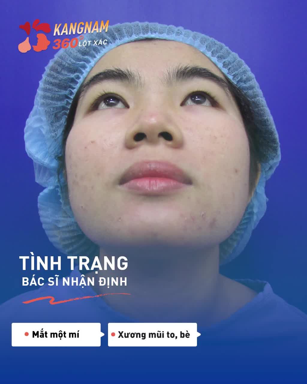 SAY ĐẮM COMBO siêu xịn CẮT MÍ  NÂNG MŨI