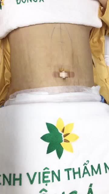 Kết quả lipo tạo hình sau 2 ngày Tại bệnh viện thẩm Mỹ Đông Á