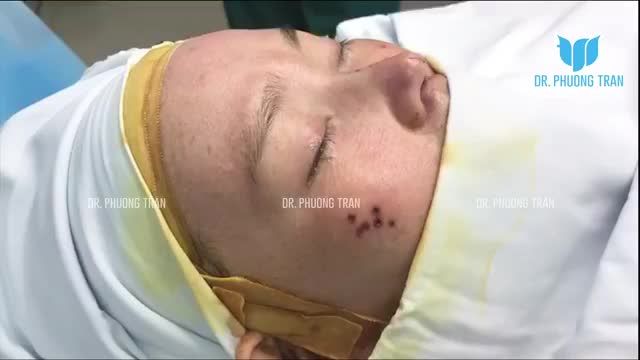 CẬP NHẬT KẾT QUẢ CA MŨI SỤN SƯỜN TỰ THÂN KẾT HỢP SỐNG MŨI SURGIFORM VÀ PHỦ MEGADERM