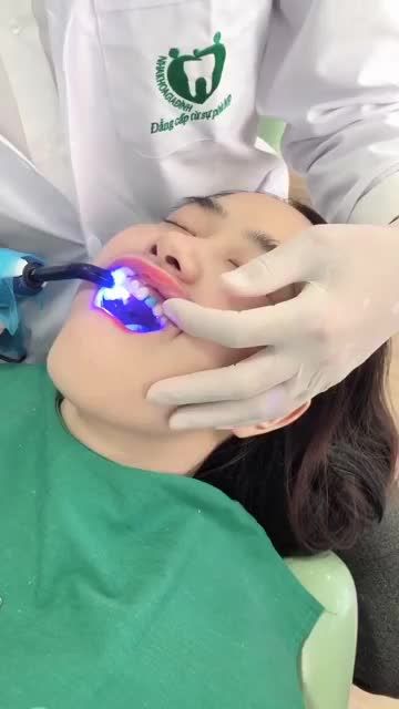 ĐIỀU TRỊ RĂNG THƯA, HÌNH THỂ NHỎ VỚI DÁN SỨ VENEER