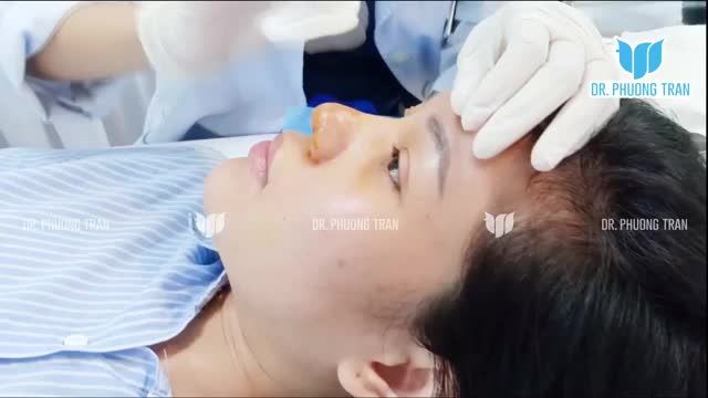 KẾT QUẢ THỰC TẾ SAU 5 NGÀY NÂNG MŨI CẤU TRÚC SURGIFORM