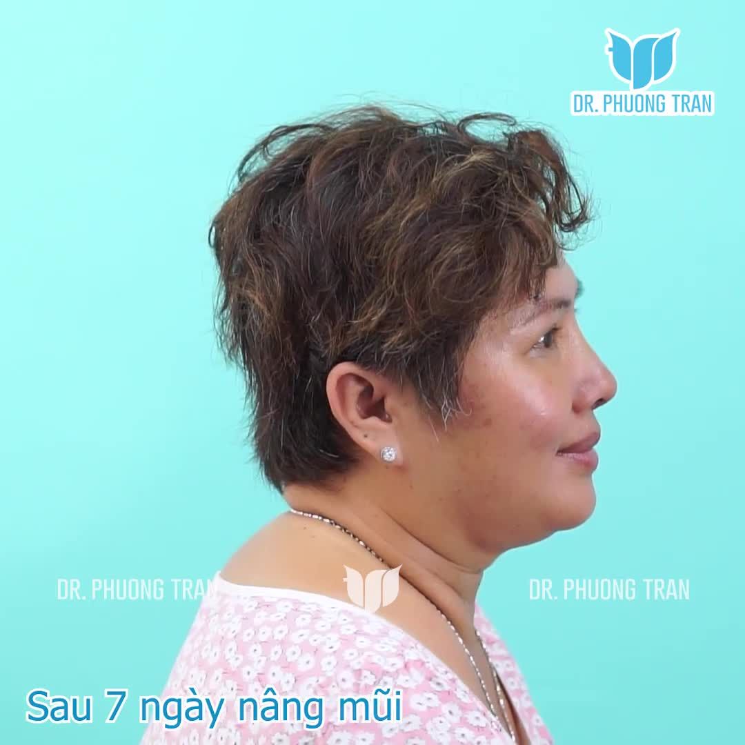 MŨI ĐẸP TỰ NHIÊN CHỈ SAU 7 NGÀY NÂNG MŨI SỤN SƯỜN