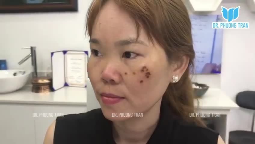 Phân tích trước phẫu thuật: Đây là một ca mũi rất khó để làm đẹp xuất sắc vì sống mũi gần như không có, da mũi lại rất mỏng