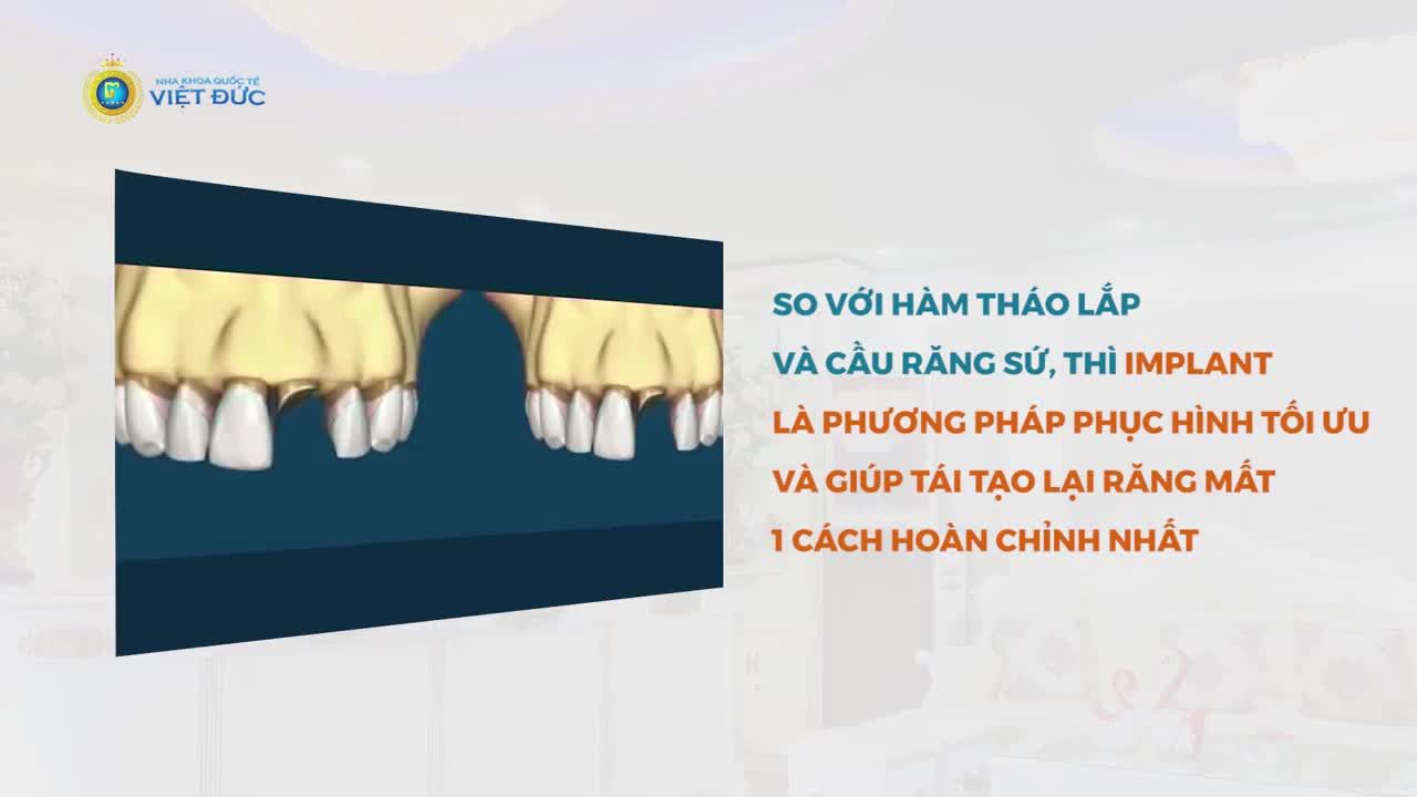 TRỒNG RĂNG IMPLANT - "NHÀ VÔ ĐỊCH" PHỤC HÌNH RĂNG MẤT