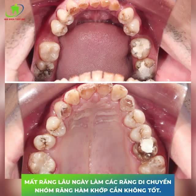 36 TUỔI SUÝT BAY CẢ HÀM RĂNG VỚI RẤT NHIỀU VẤN ĐỀ RĂNG MIỆNG
