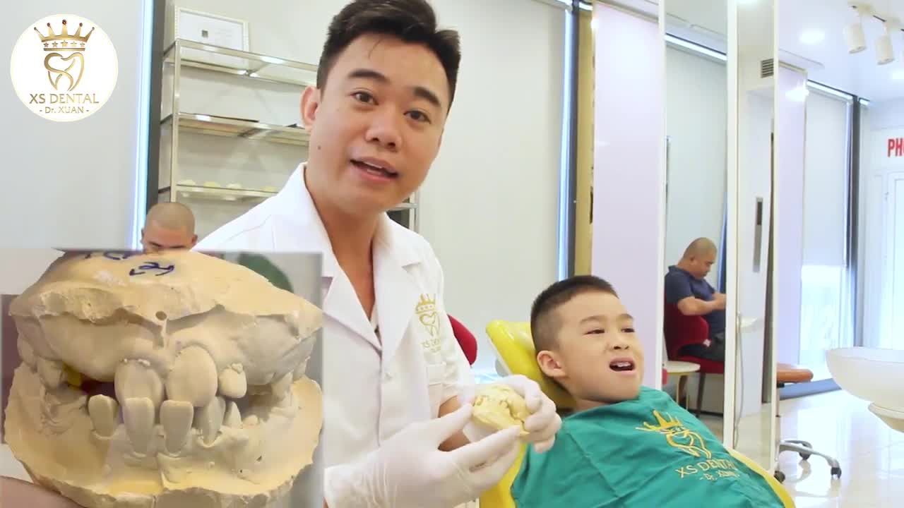 Bé Lê Bảo Sơn, 9 tuổi Sau 2 tháng niềng răng tại Nha khoa XS