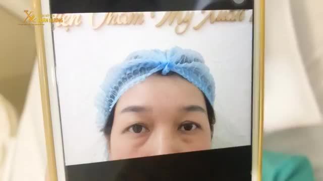 CẮT MÍ TRÊN + DƯỚI ĐẸP NGAY SAU KHI THỰC HIỆN XONG TẠI TMV XUÂN HƯƠNG
