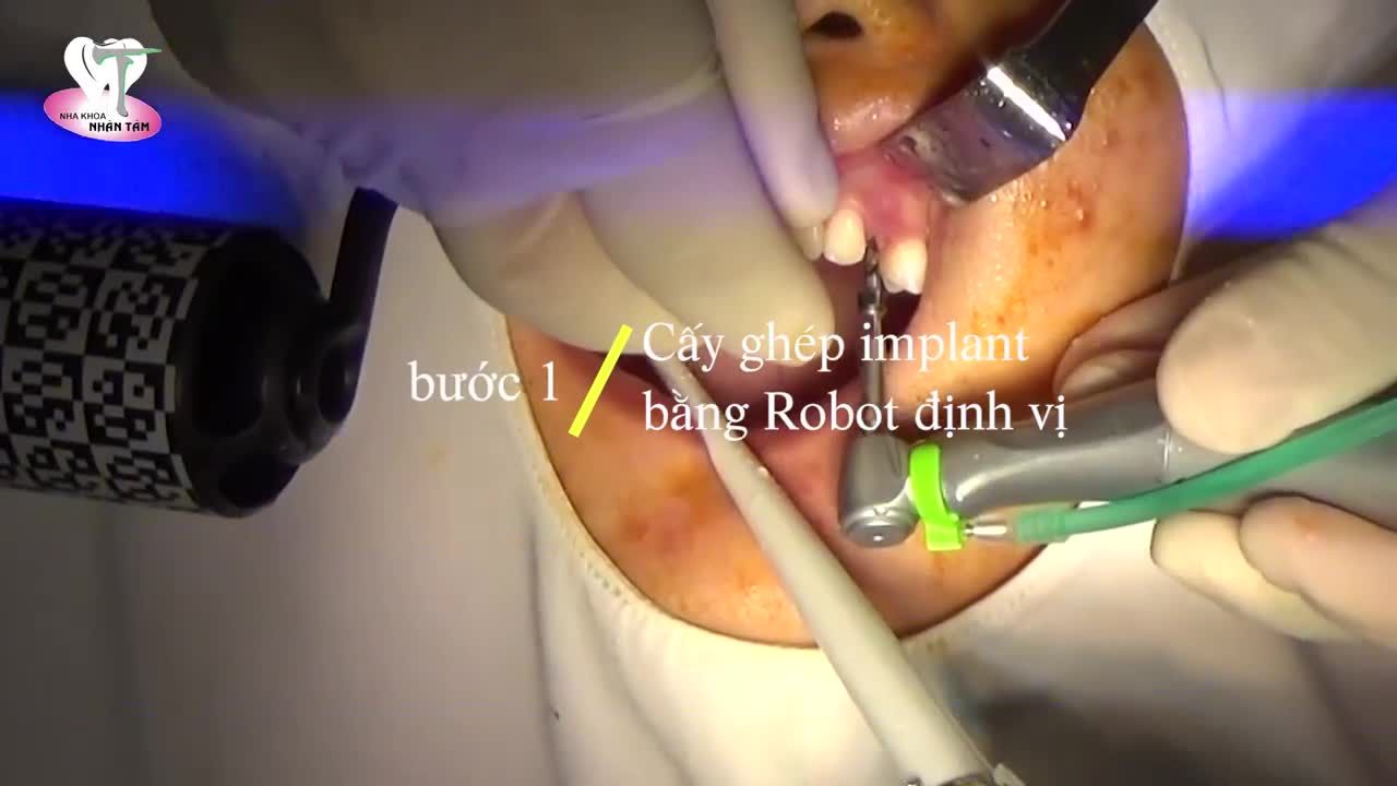 Chị T., 20 tuổi, thiếu răng R23 từ nhỏ.
