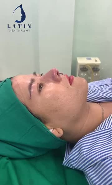 Combo nâng cung đa tầng và mũi tái cấu trúc lần 3
