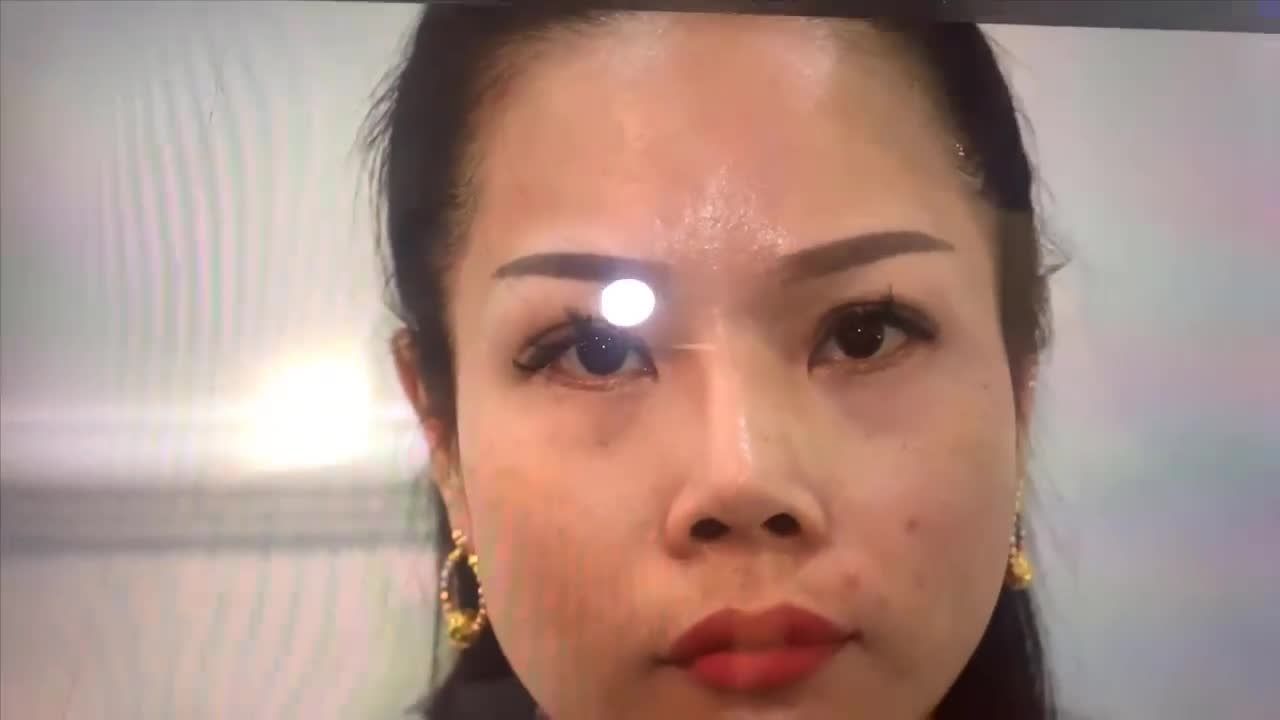 Cùng giao lưu với Dr.Thông tái khám cho bạn gái mũi hỏng sửa lại sau 10 ngày nâng mũi cấu trúc
